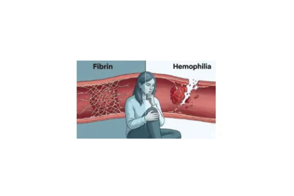 Hemophilia