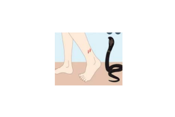 snakebite